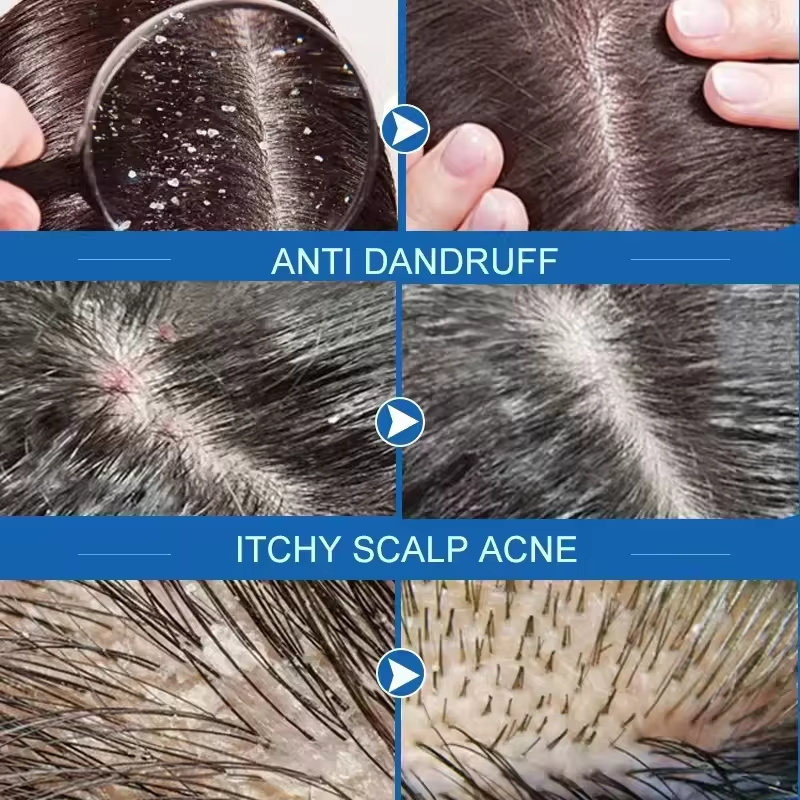 Savon de traitement Anti-pelli - Hair Care Dandruff avis et prix