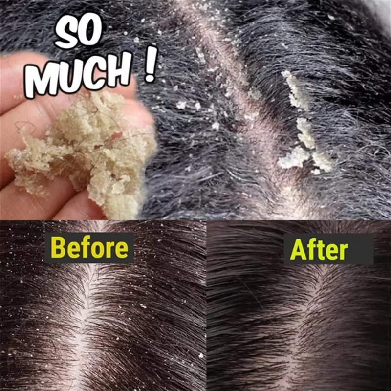 Savon de traitement Anti-pelli - Hair Care Dandruff avis et prix